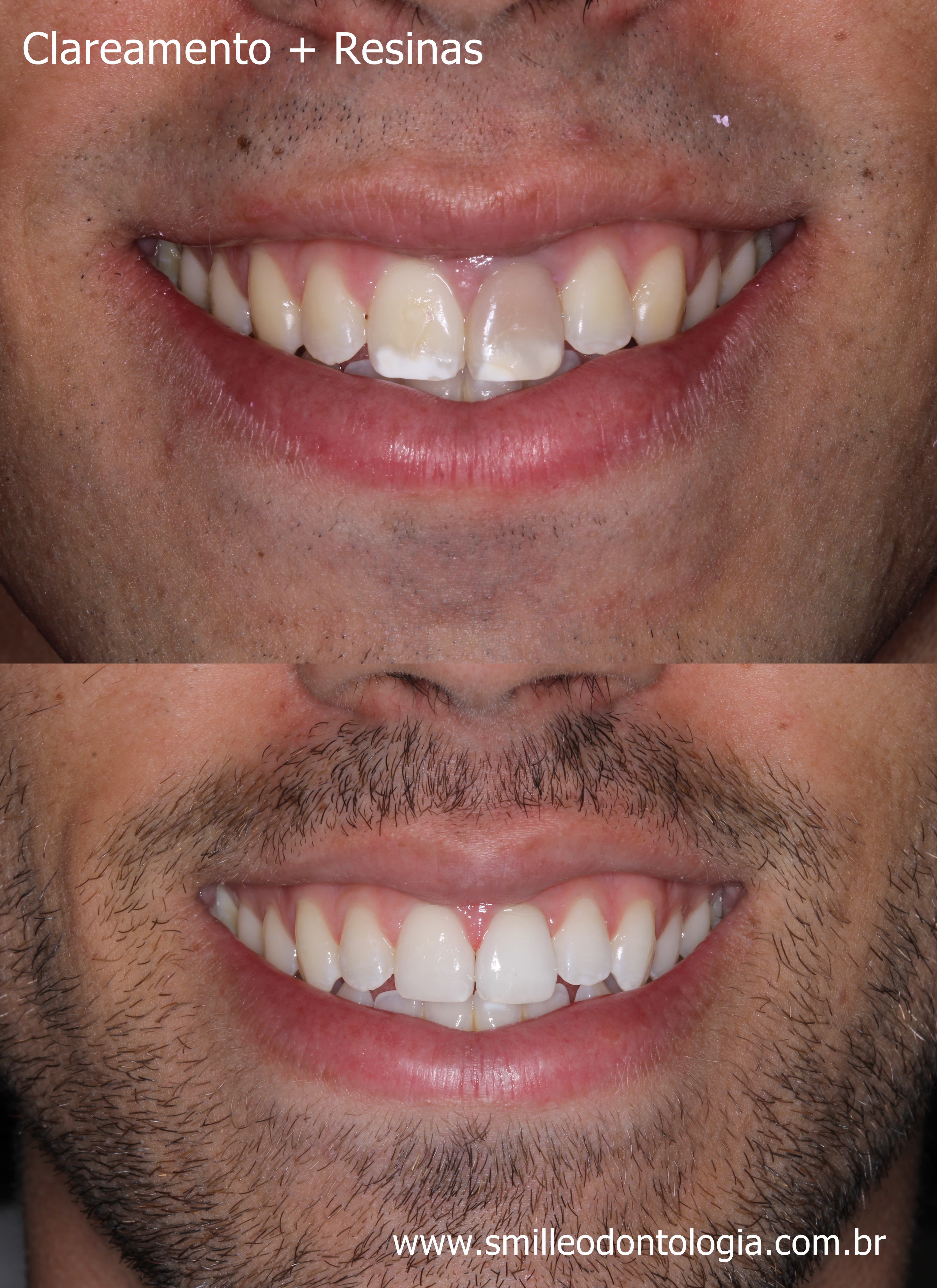 Exemplo de sorriso antes e depois do clareamento